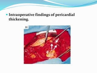  Intraoperative findings of pericardial
thickening.
 