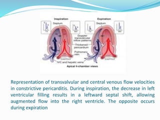 Representation of transvalvular and central venous flow velocities
in constrictive pericarditis. During inspiration, the decrease in left
ventricular filling results in a leftward septal shift, allowing
augmented flow into the right ventricle. The opposite occurs
during expiration
 