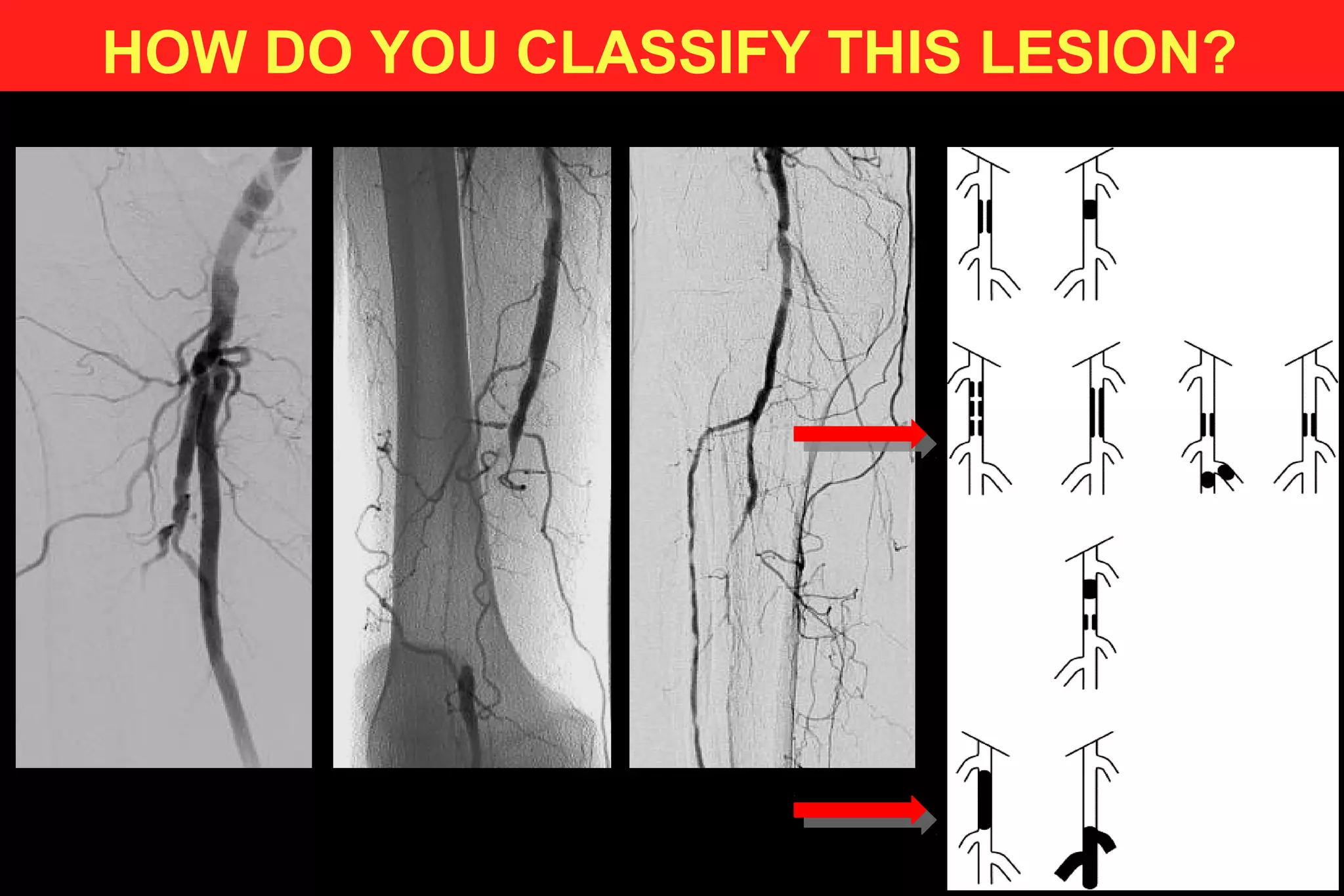HOW DO YOU CLASSIFY THIS LESION?
 