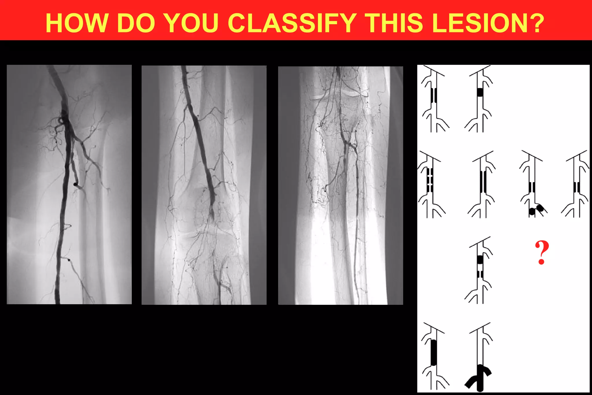 HOW DO YOU CLASSIFY THIS LESION?
?
 