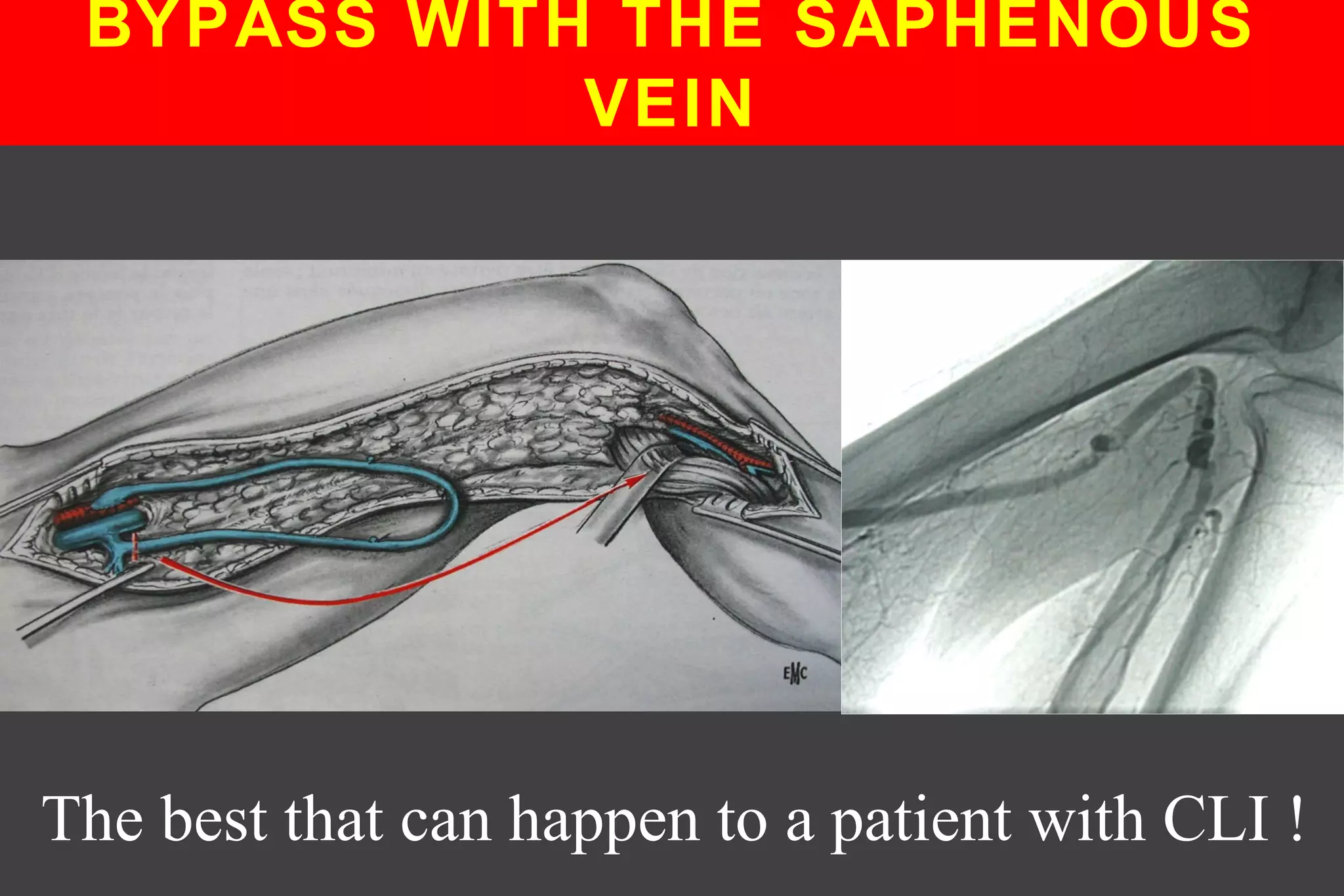 BYPASS WITH THE SAPHENOUS
VEIN
The best that can happen to a patient with CLI !
 