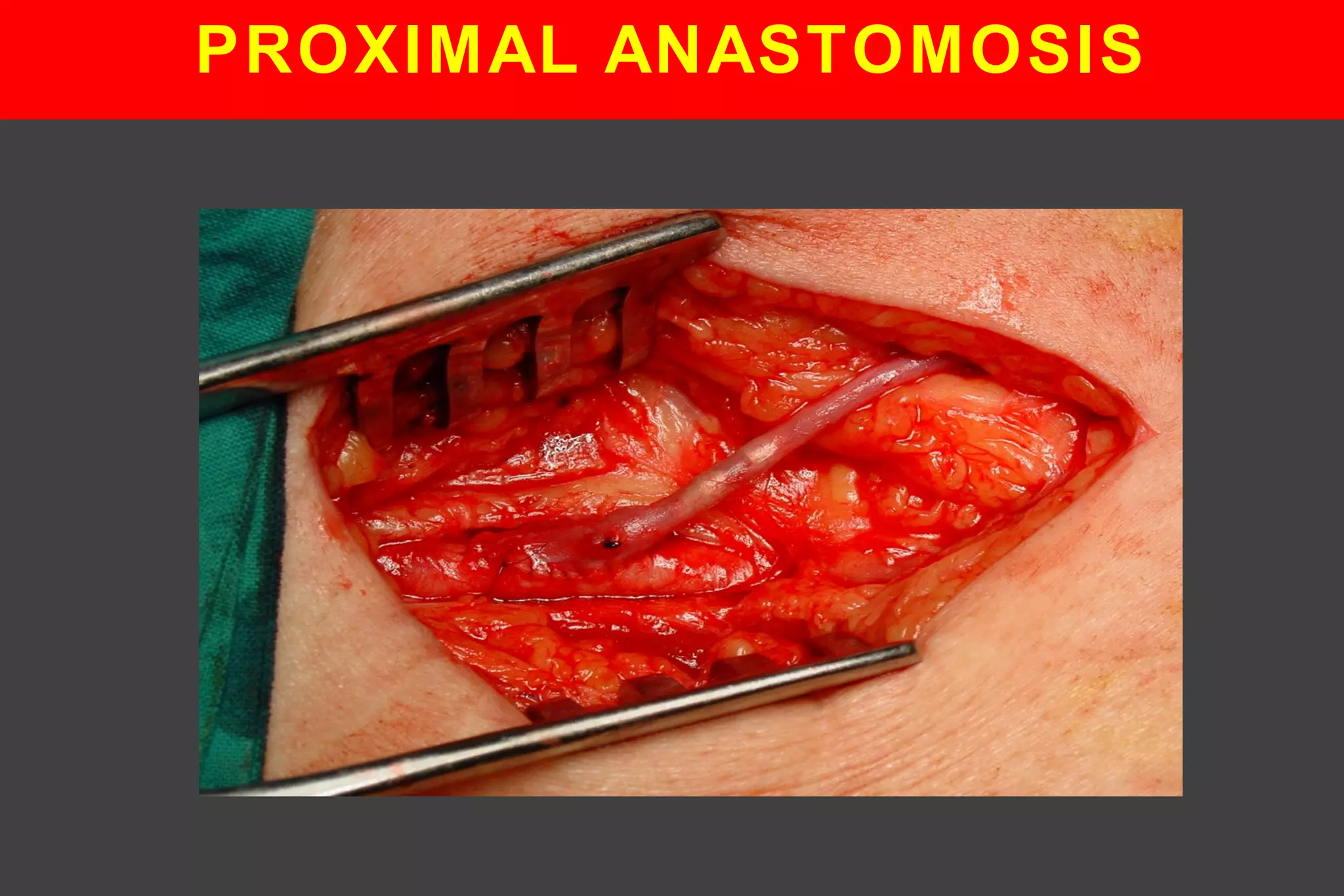PROXIMAL ANASTOMOSIS
 