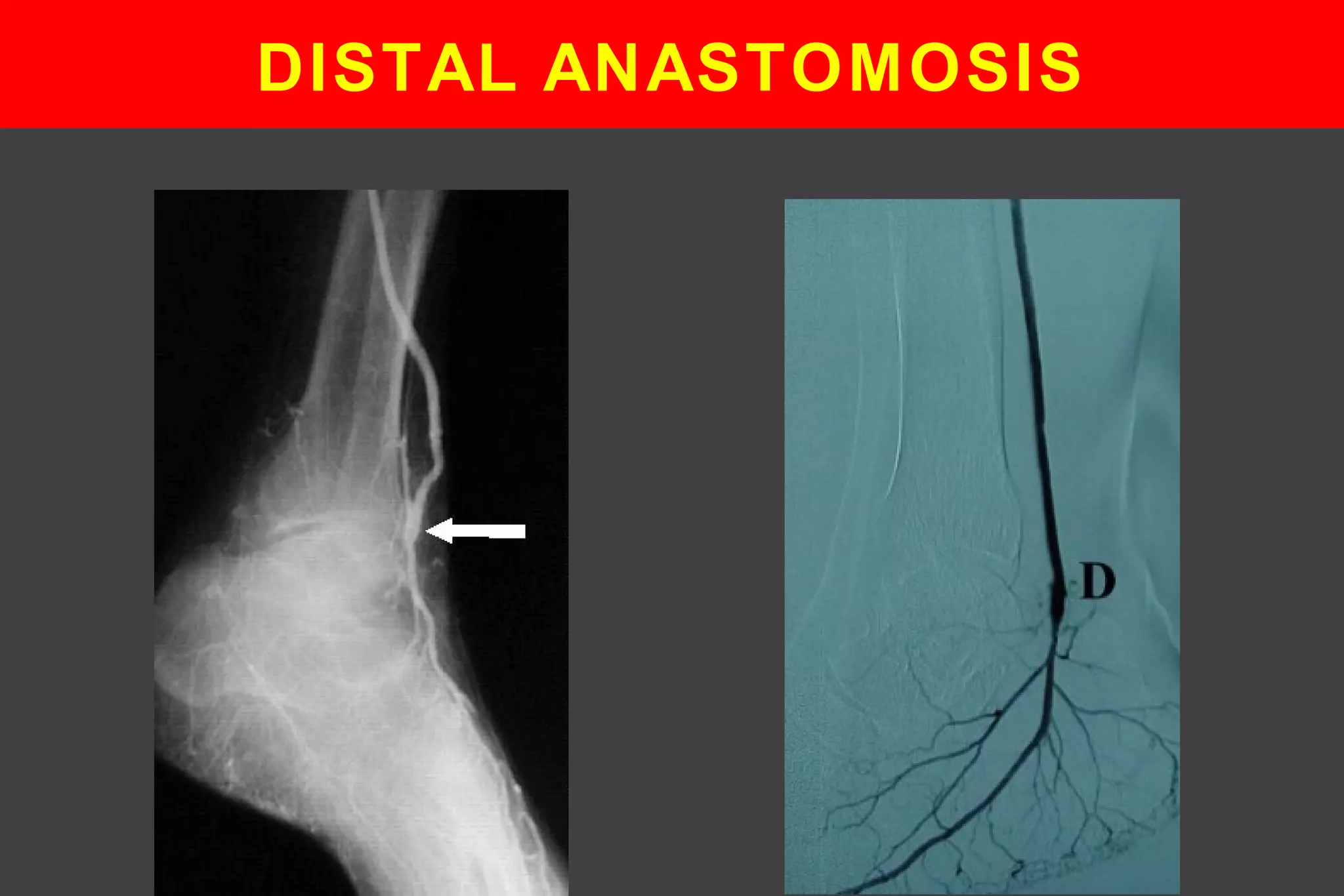 DISTAL ANASTOMOSIS
 