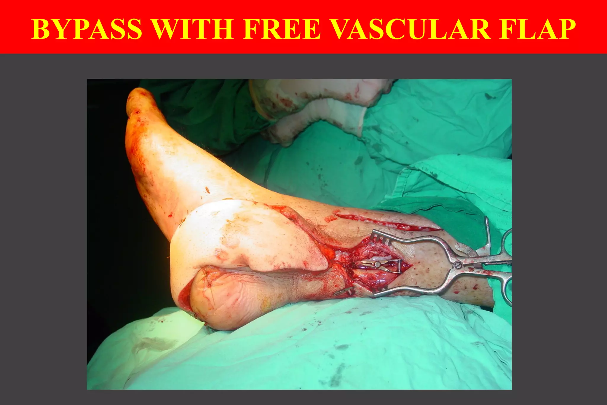 BYPASS WITH FREE VASCULAR FLAP
 
