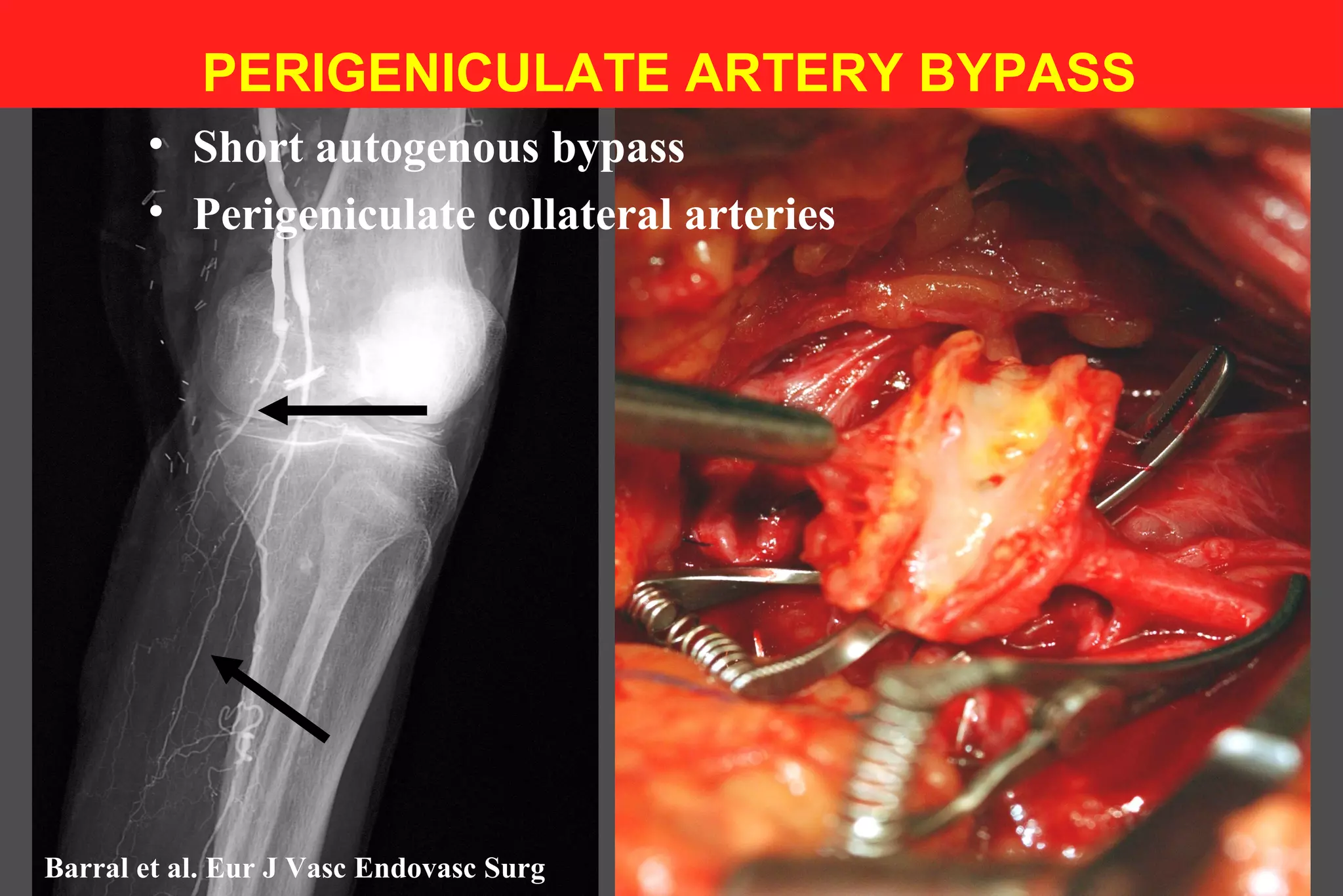 • Short autogenous bypass
• Perigeniculate collateral arteries
PERIGENICULATE ARTERY BYPASS
Barral et al. Eur J Vasc Endovasc Surg
 