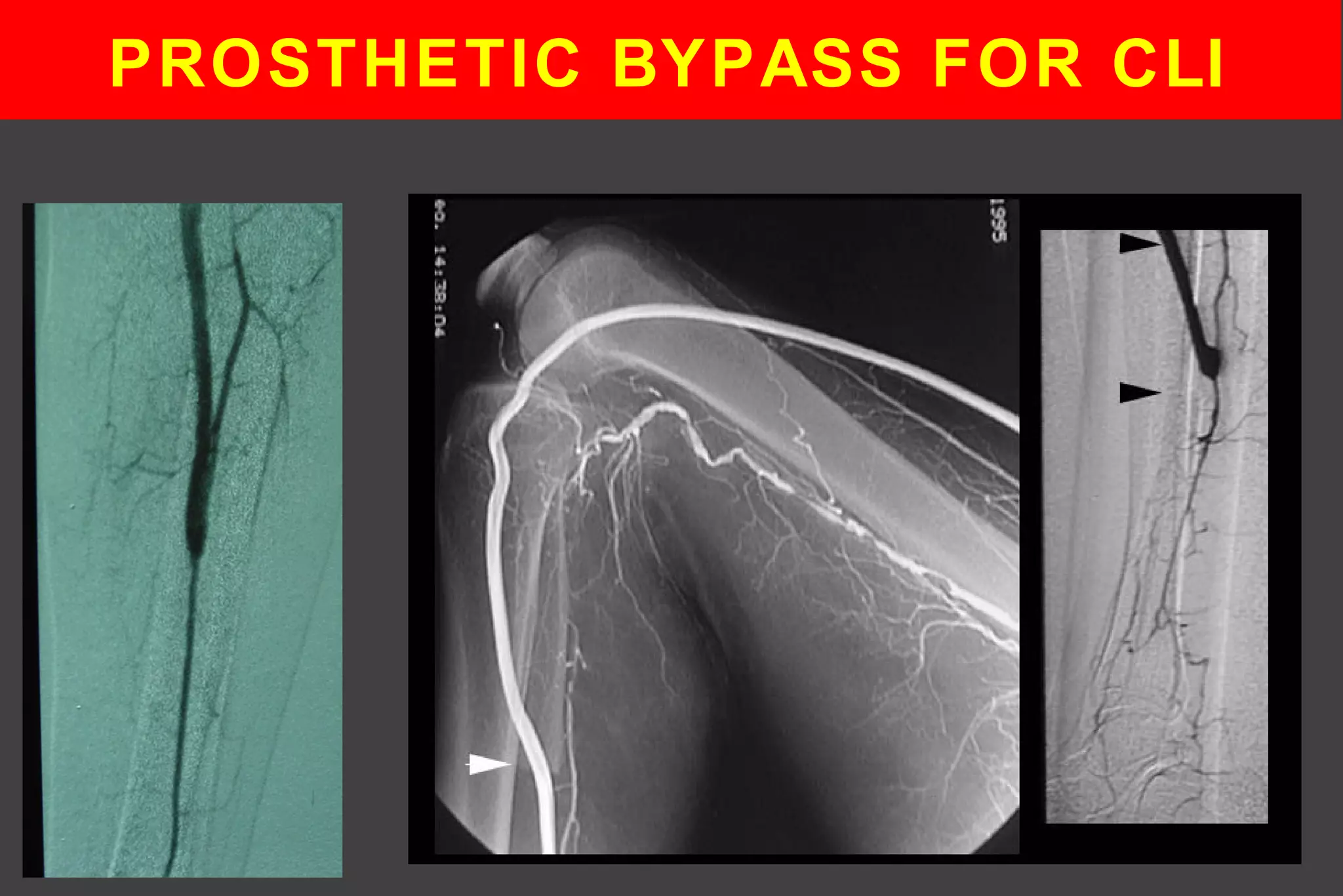 PROSTHETIC BYPASS FOR CLI
 