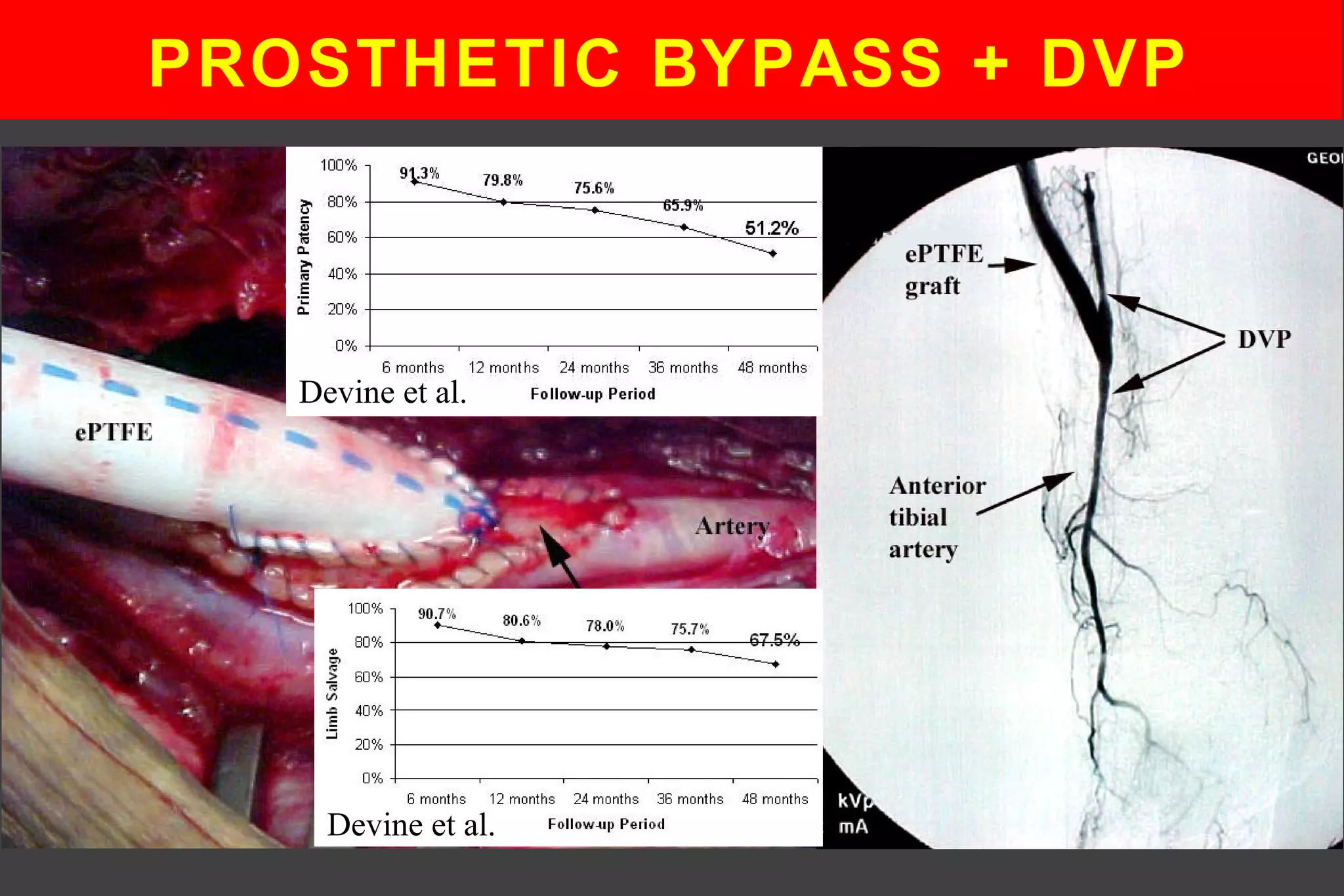 PROSTHETIC BYPASS + DVP
Devine et al.
Devine et al.
 