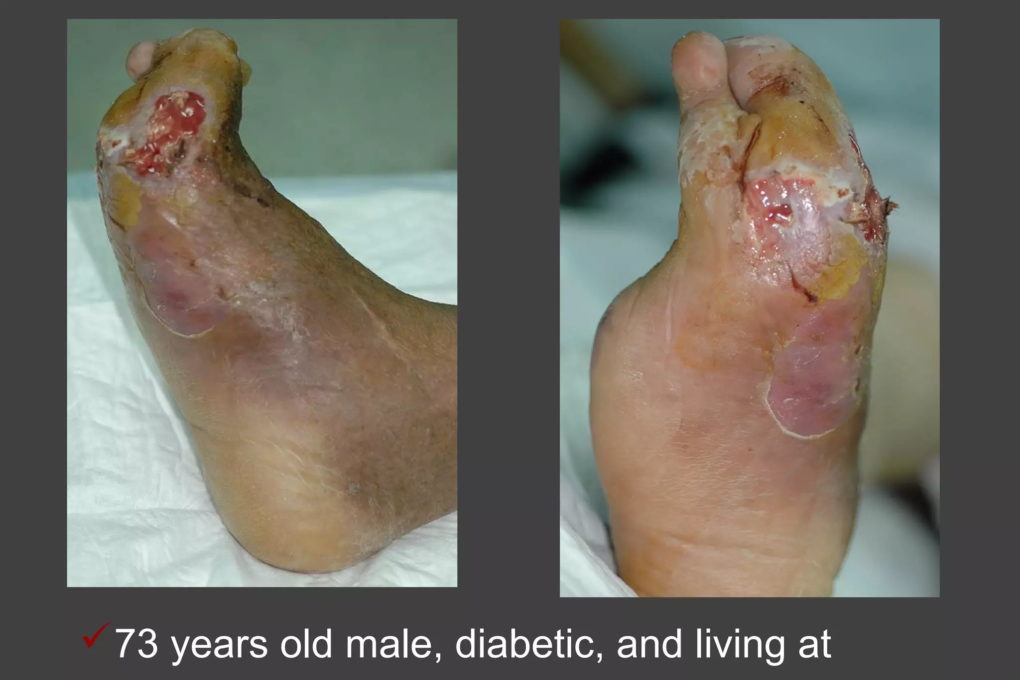 73 years old male, diabetic, and living at
 