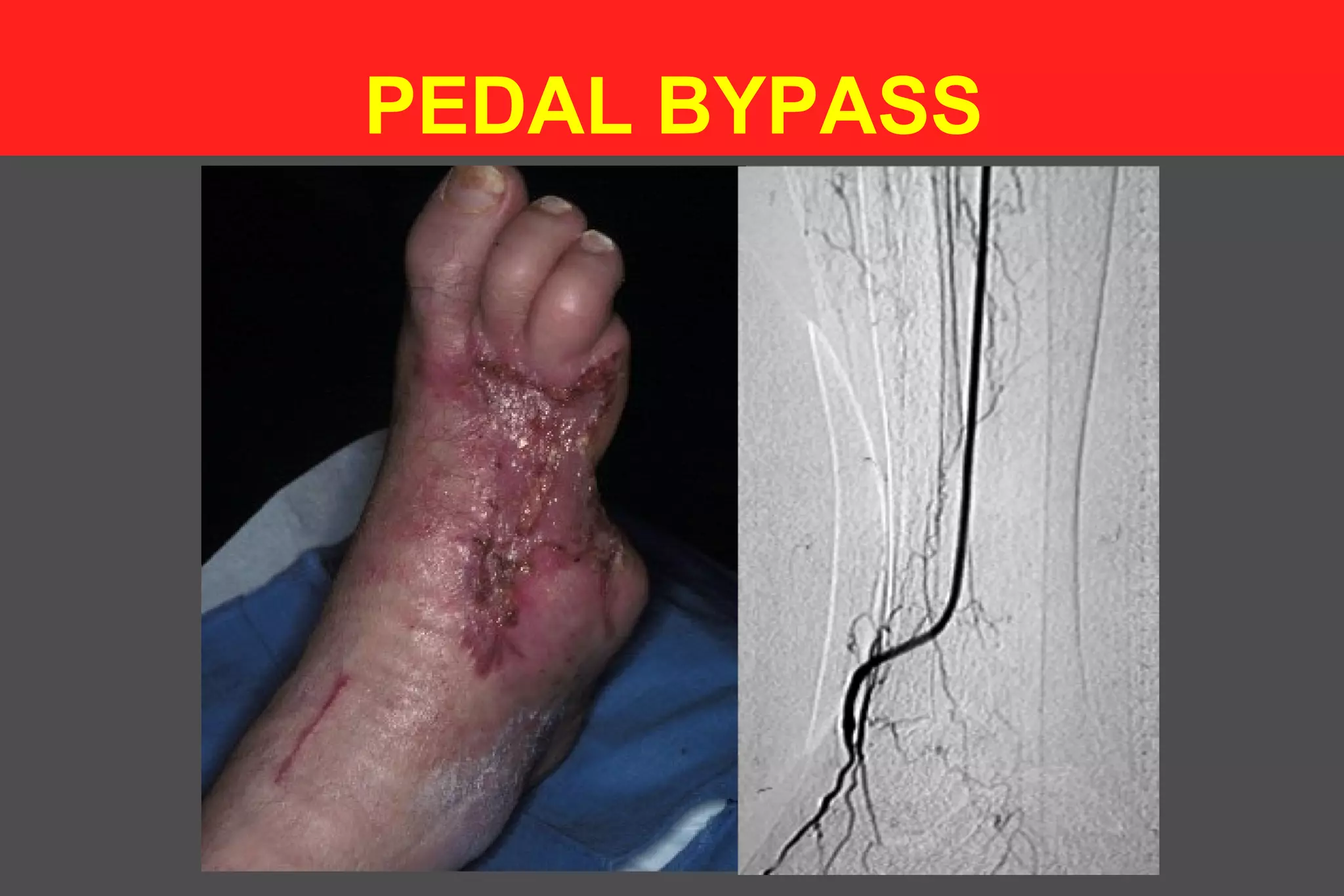 PEDAL BYPASS
 