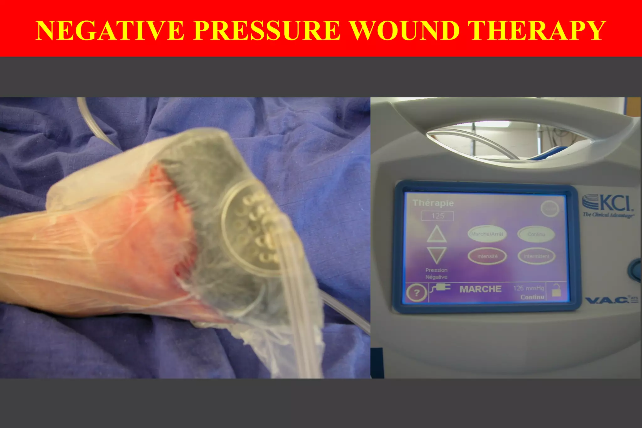 NEGATIVE PRESSURE WOUND THERAPY
 
