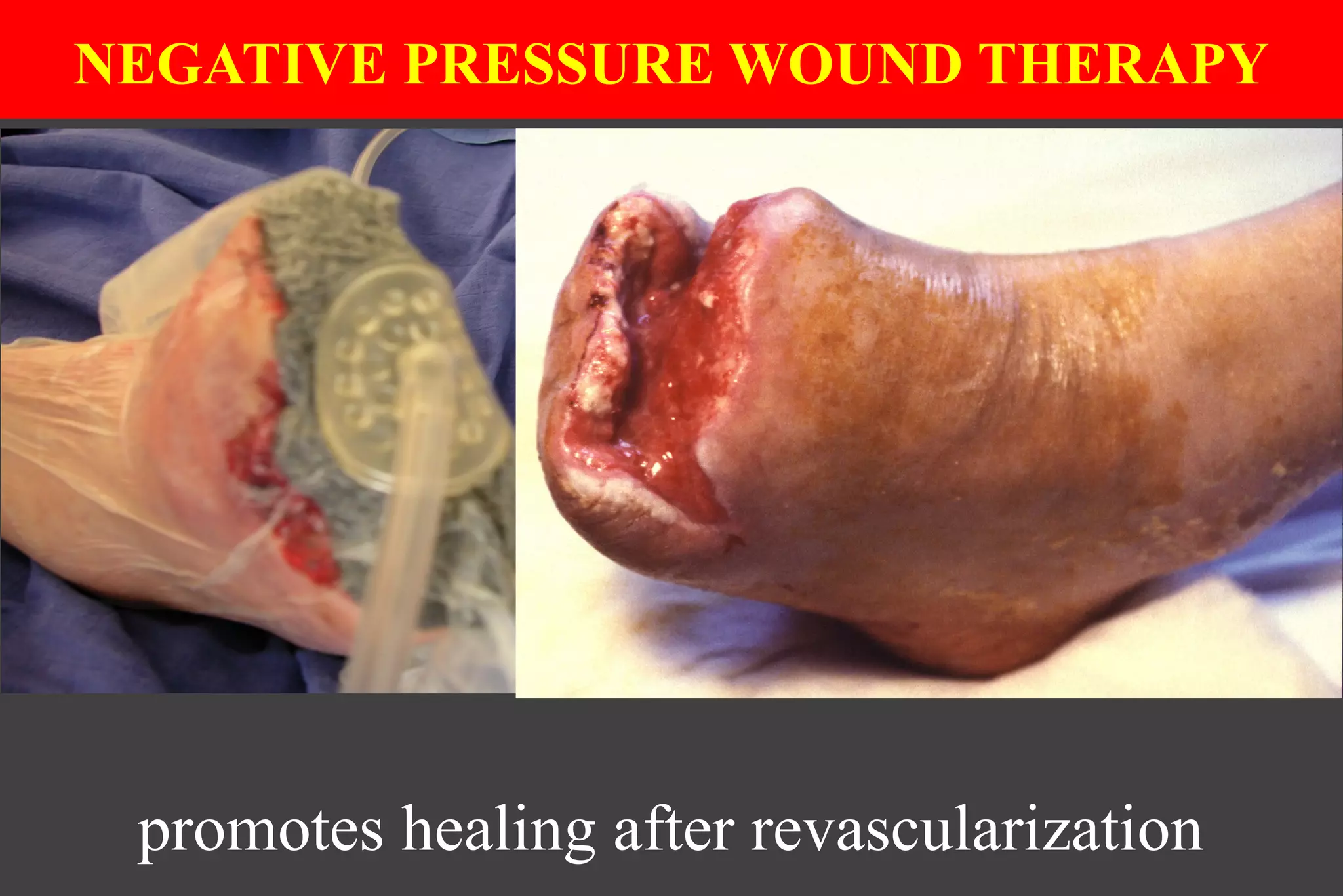 promotes healing after revascularization
NEGATIVE PRESSURE WOUND THERAPY
 