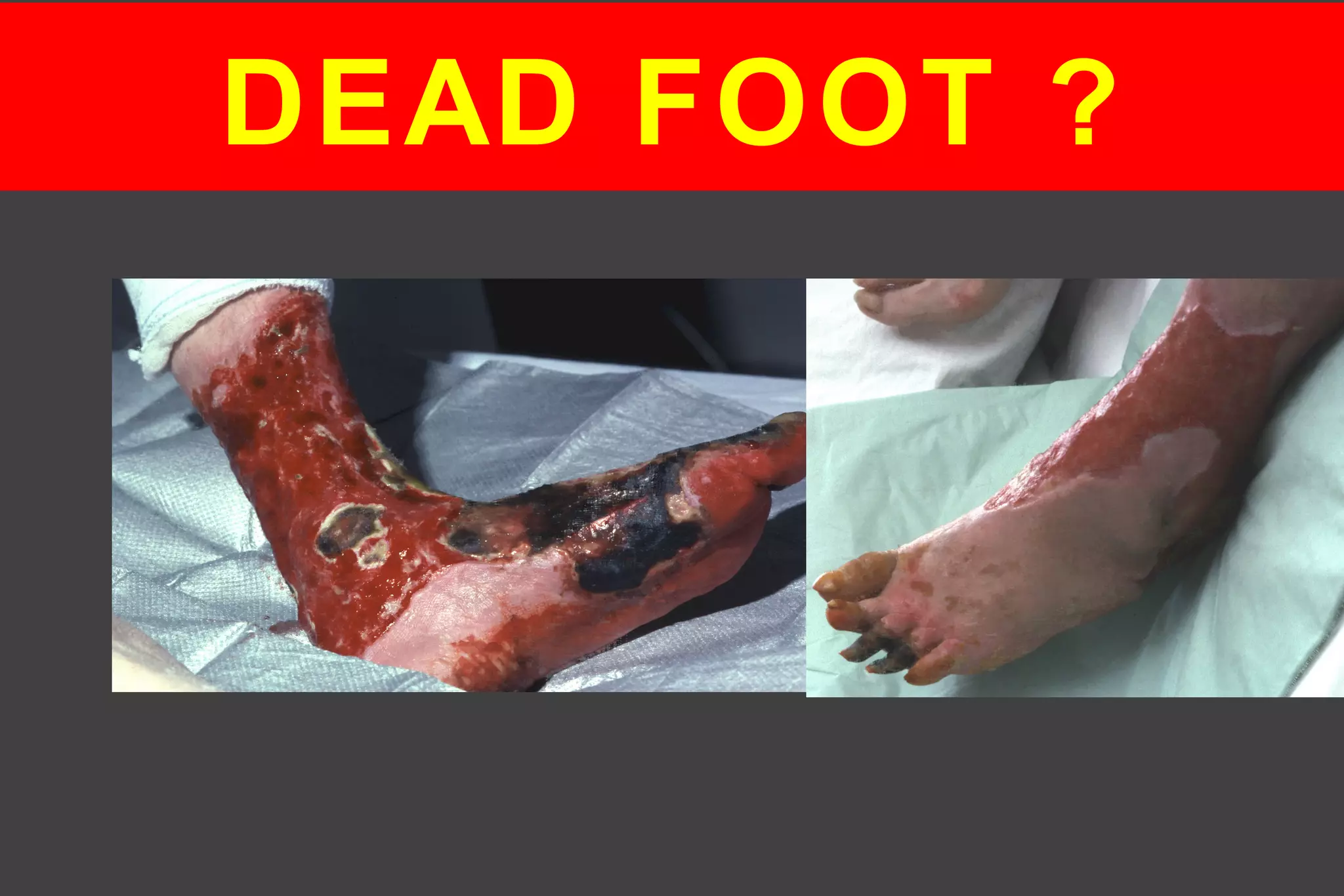 DEAD FOOT ?
 