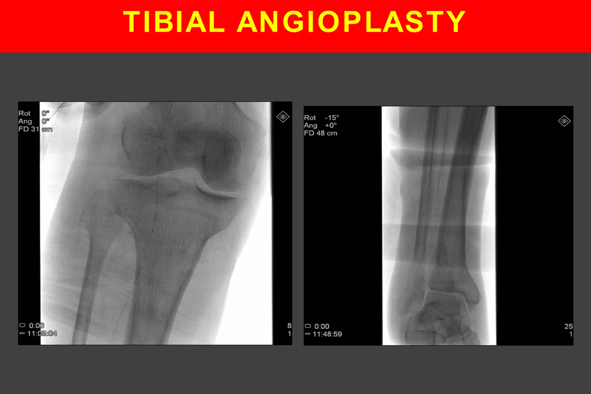 TIBIAL ANGIOPLASTY
 