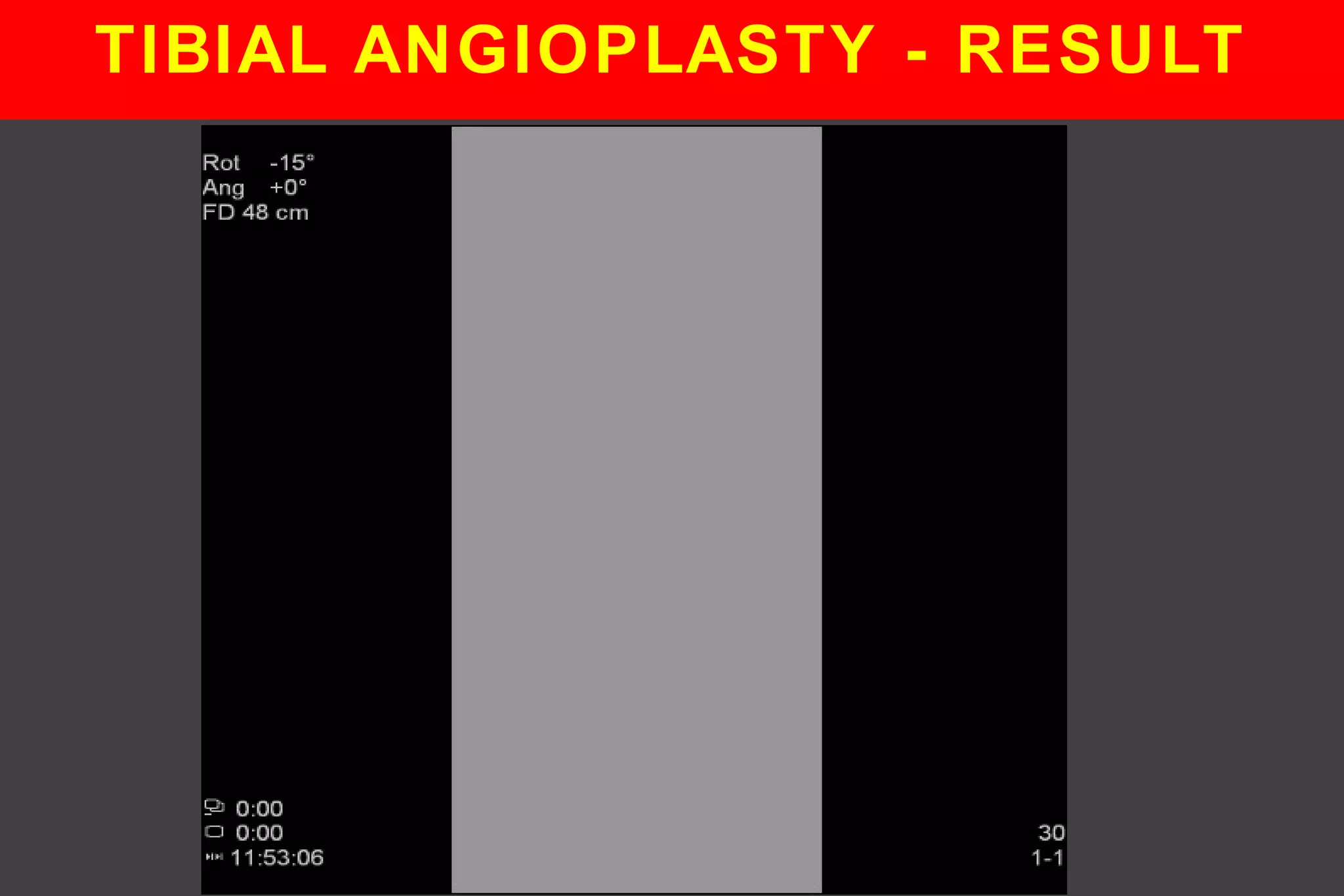 TIBIAL ANGIOPLASTY - RESULT
 