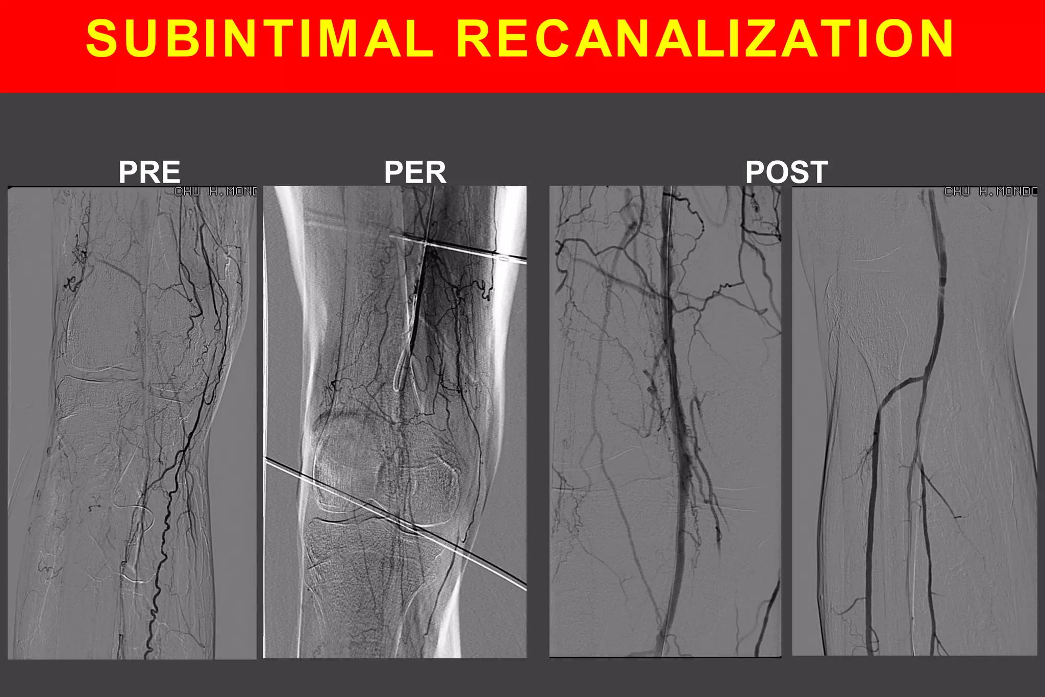 PRE PER POST
SUBINTIMAL RECANALIZATION
 