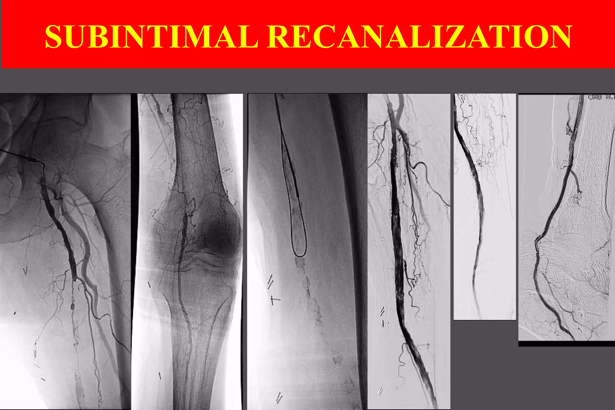 SUBINTIMAL RECANALIZATION
 