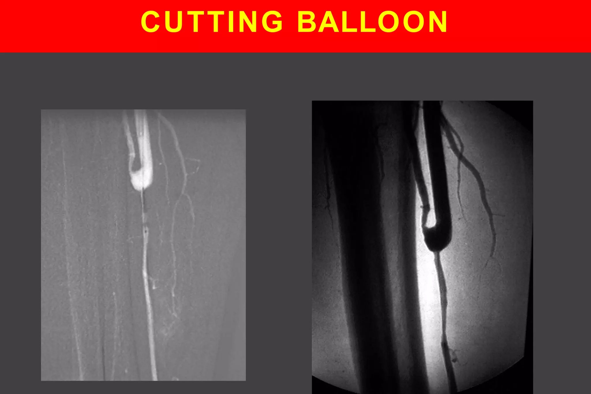 CUTTING BALLOON
 