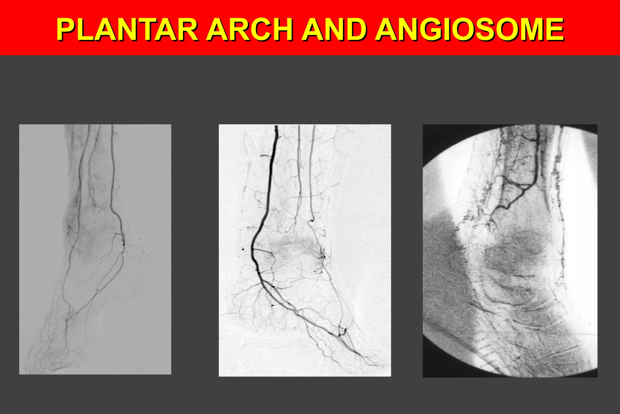PLANTAR ARCH AND ANGIOSOMEPLANTAR ARCH AND ANGIOSOME
 