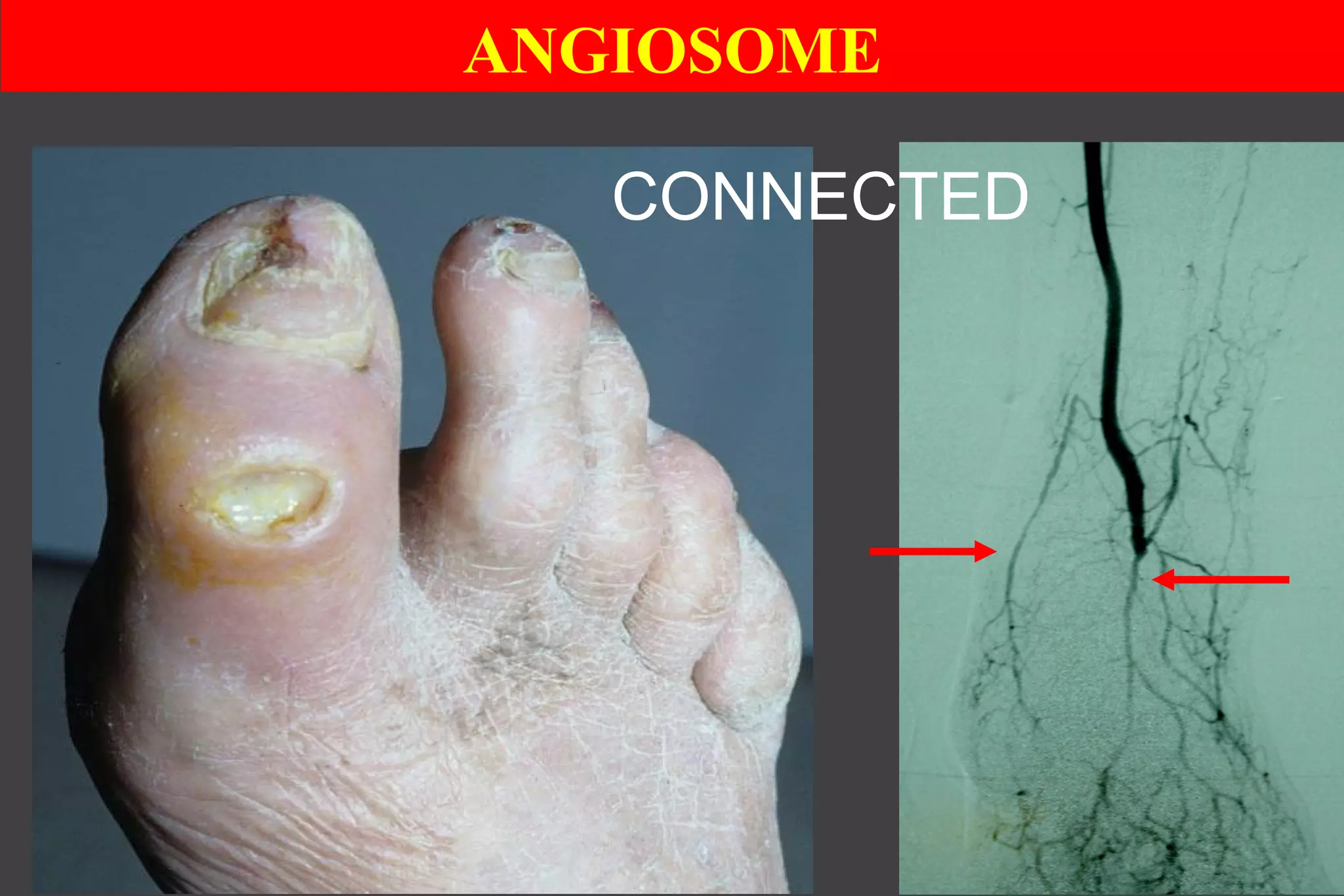 ANGIOSOME
CONNECTED
 