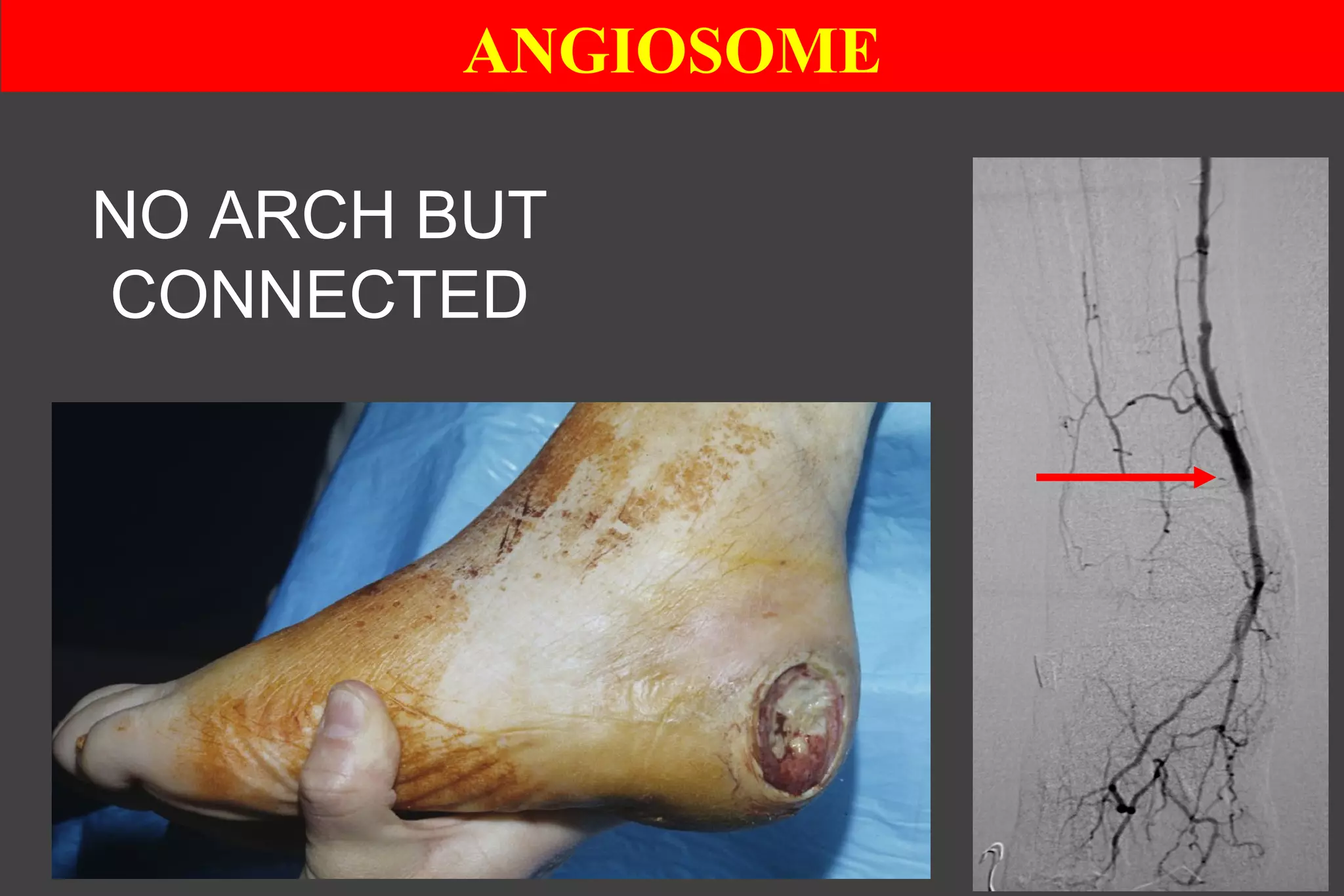 ANGIOSOME
NO ARCH BUT
CONNECTED
 