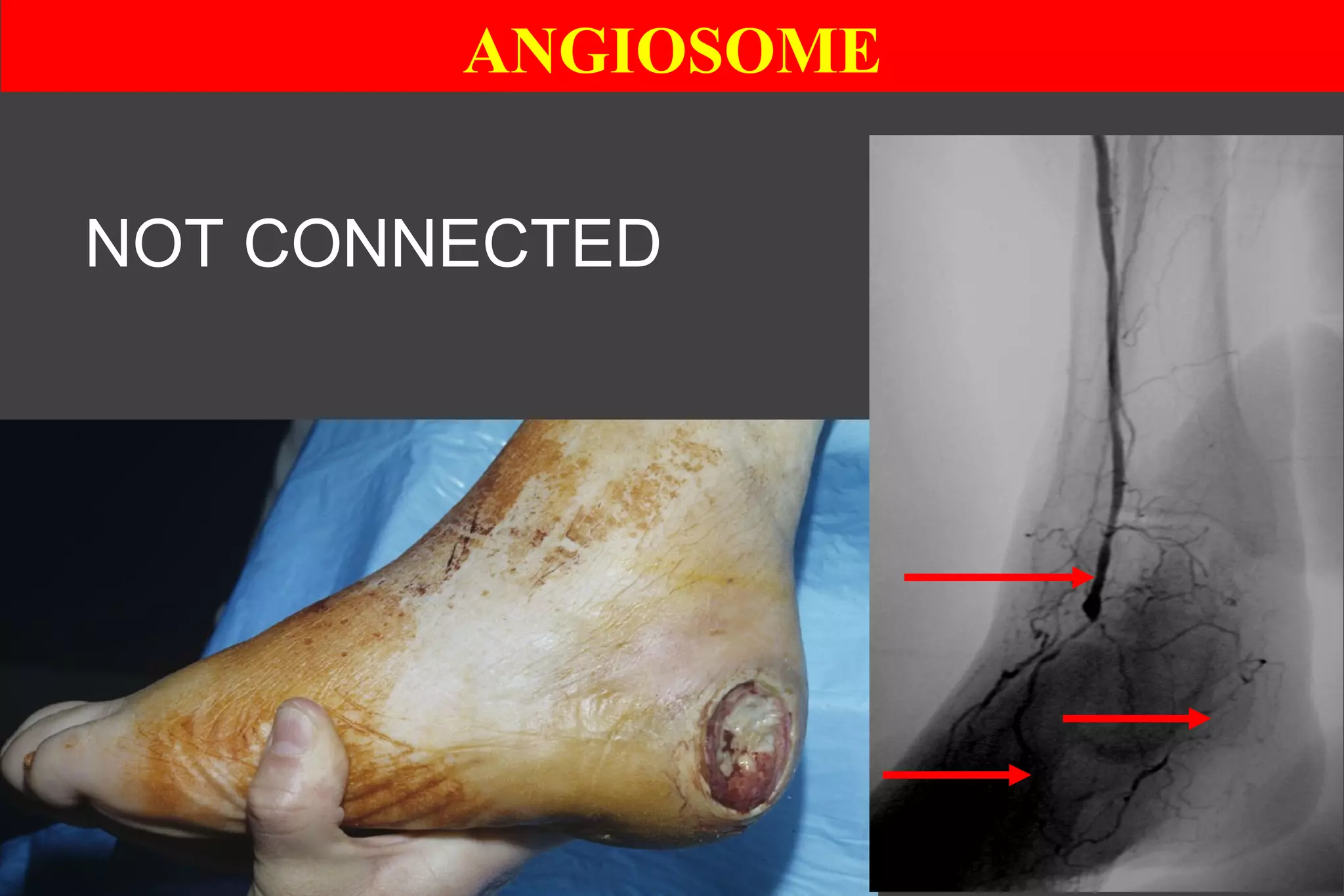 ANGIOSOME
NOT CONNECTED
 