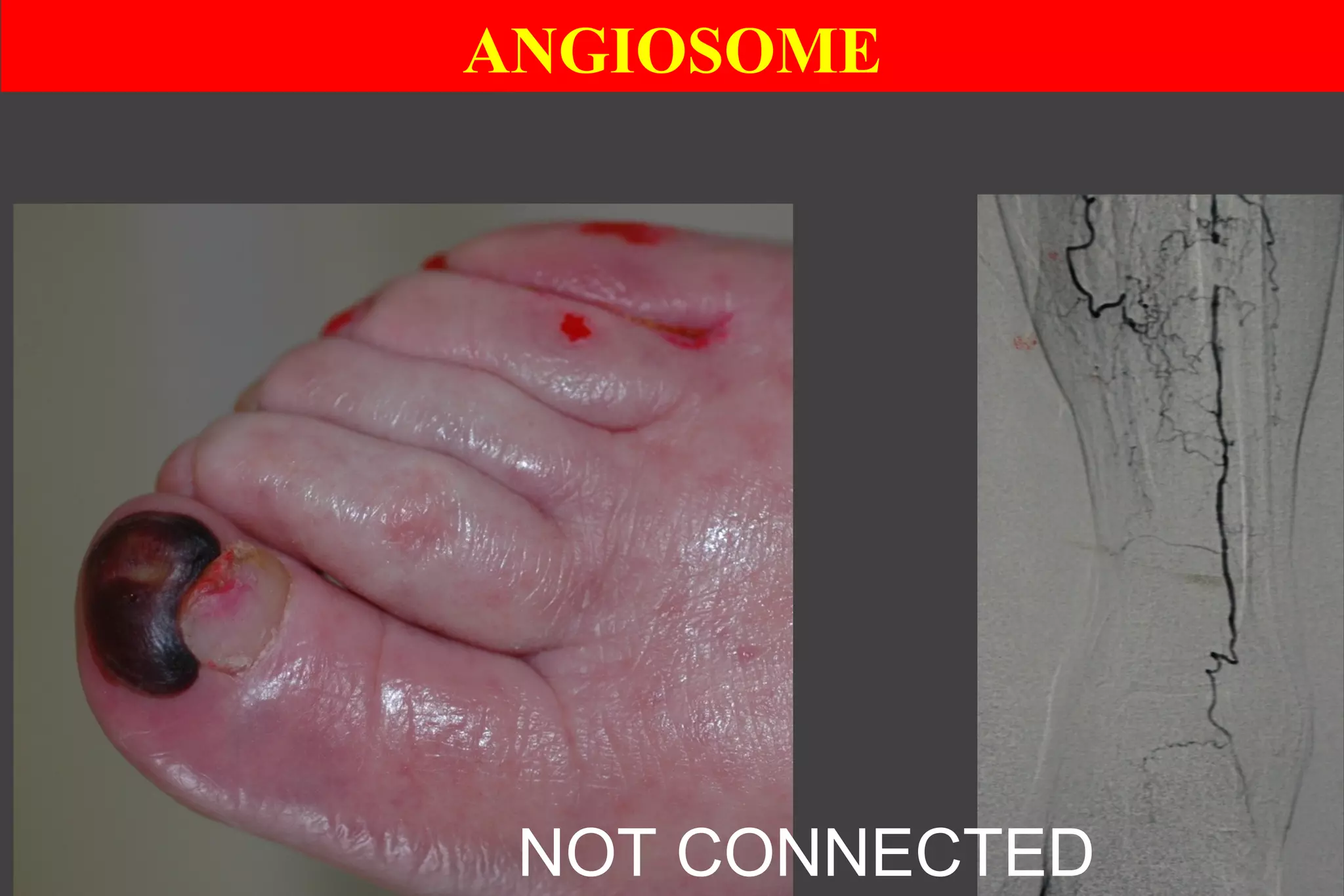 NOT CONNECTED
ANGIOSOME
 