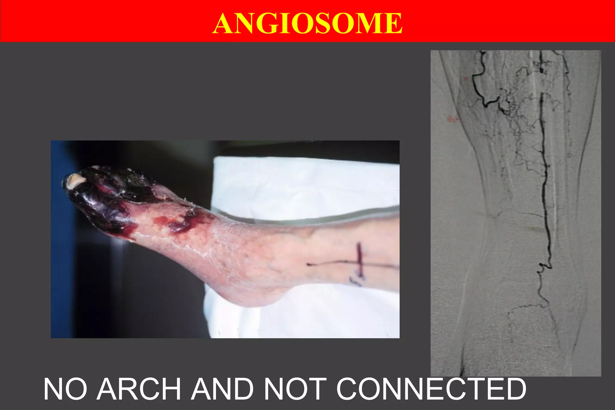 ANGIOSOME
NO ARCH AND NOT CONNECTED
 