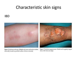 Characteristic skin signs
IBD
 