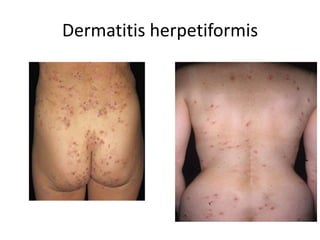 Dermatitis herpetiformis
 