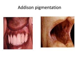 Addison pigmentation
 