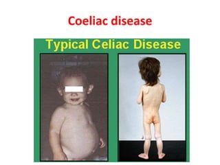 Coeliac disease
 