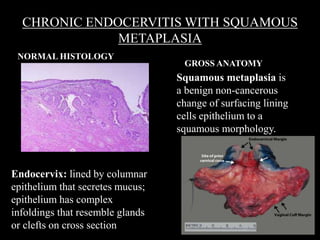 CHRONIC ENDOCERVITIS WITH SQUAMOUS
METAPLASIA
NORMAL HISTOLOGY
GROSS ANATOMY
Endocervix: lined by columnar
epithelium that secretes mucus;
epithelium has complex
infoldings that resemble glands
or clefts on cross section
Squamous metaplasia is
a benign non-cancerous
change of surfacing lining
cells epithelium to a
squamous morphology.
 