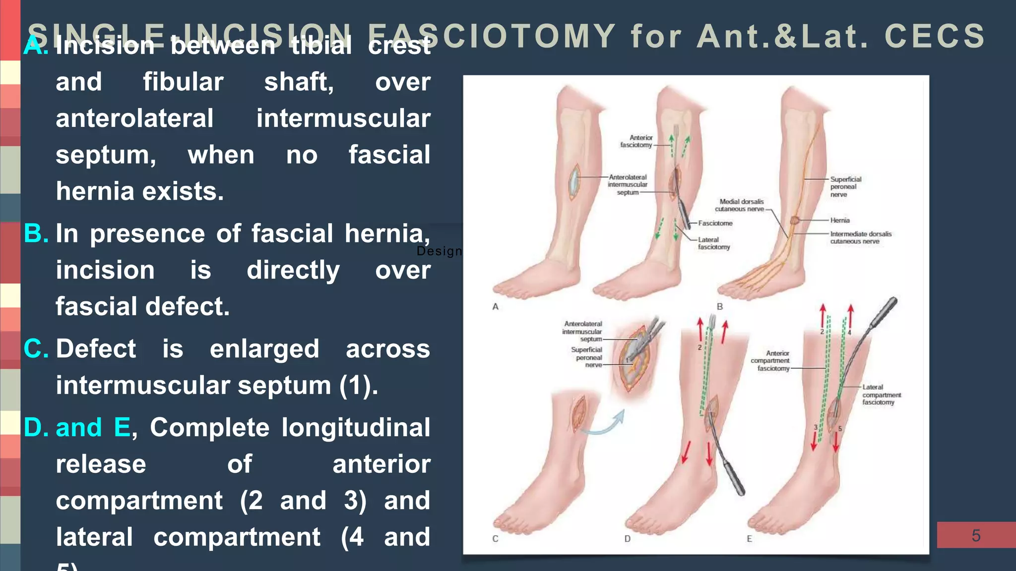 Chronic Exertional Compartment Syndrome