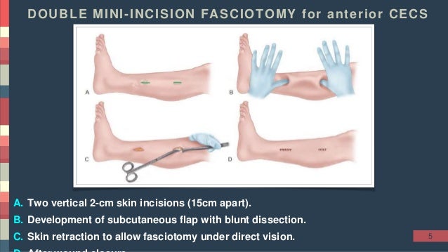 Chronic Exertional Compartment Syndrome