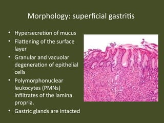 Chronic gastritis. GERD. Peptic ulcer (1).pptx