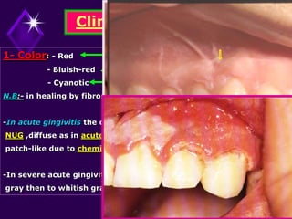 Clinical Features
1- Color: - Red V.D. of capillary bed, keratinization
- Bluish-red b1. stasis
- Cyanotic 02 tension
N.B:- in healing by fibrosis pale pink.
-In acute gingivitis the color change may be marginal as in
NUG ,diffuse as in acute herpetic gingivostomatitis or
patch-like due to chemical irritation.
-In severe acute gingivitis, the red color change to a shiny
gray then to whitish gray due to necrosis.
 