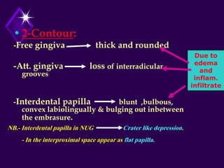Due to
edema
and
inflam.
infiltrate
•2-Contour:
-Free gingiva thick and rounded
-Att. gingiva loss of interradicular
grooves
-Interdental papilla blunt ,bulbous,
convex labiolingually & bulging out inbetween
the embrasure.
NB.- Interdental papilla in NUG Crater like depression.
- In the interproximal space appear as flat papilla.
 