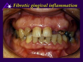 Fibrotic gingival inflammation
 