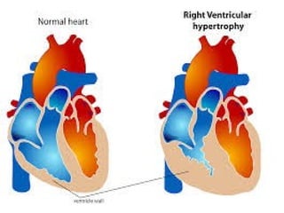 congestive heart failure in the work of GP.pptx