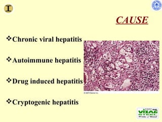 CAUSE
Chronic viral hepatitis

Autoimmune hepatitis

Drug induced hepatitis

Cryptogenic hepatitis
 