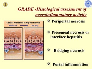 GRADE -Histological assessment of
      necroinflammatory activity
              Periportal necrosis

              Piecemeal necrosis or
              interface hepatitis


              Bridging necrosis


              Portal inflammation
 