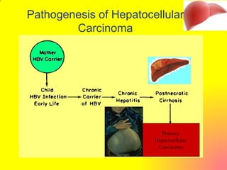 Pathogenesis of Hepatocellular
Carcinoma
Primary
Hepatocellular
Carcinoma
 