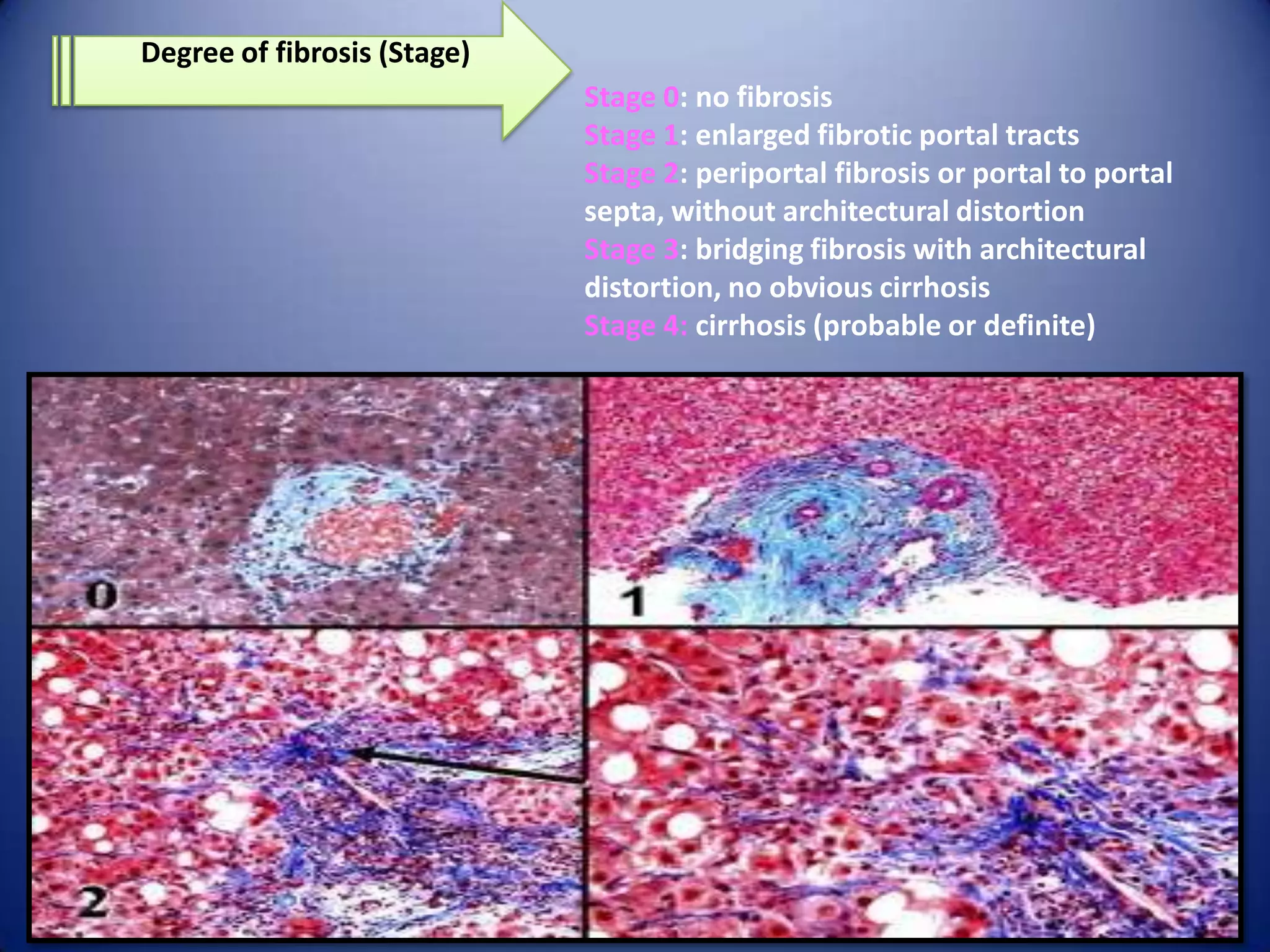 Degree of fibrosis (Stage)
Stage 0: no fibrosis
Stage 1: enlarged fibrotic portal tracts
Stage 2: periportal fibrosis or portal to portal
septa, without architectural distortion
Stage 3: bridging fibrosis with architectural
distortion, no obvious cirrhosis
Stage 4: cirrhosis (probable or definite)

 