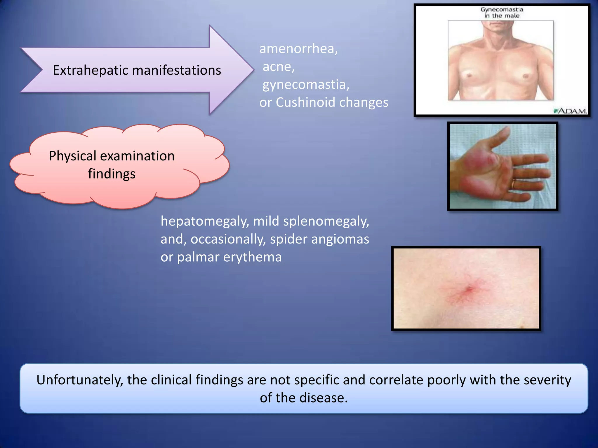 Extrahepatic manifestations

amenorrhea,
acne,
gynecomastia,
or Cushinoid changes

Physical examination
findings

hepatomegaly, mild splenomegaly,
and, occasionally, spider angiomas
or palmar erythema

Unfortunately, the clinical findings are not specific and correlate poorly with the severity
of the disease.

 