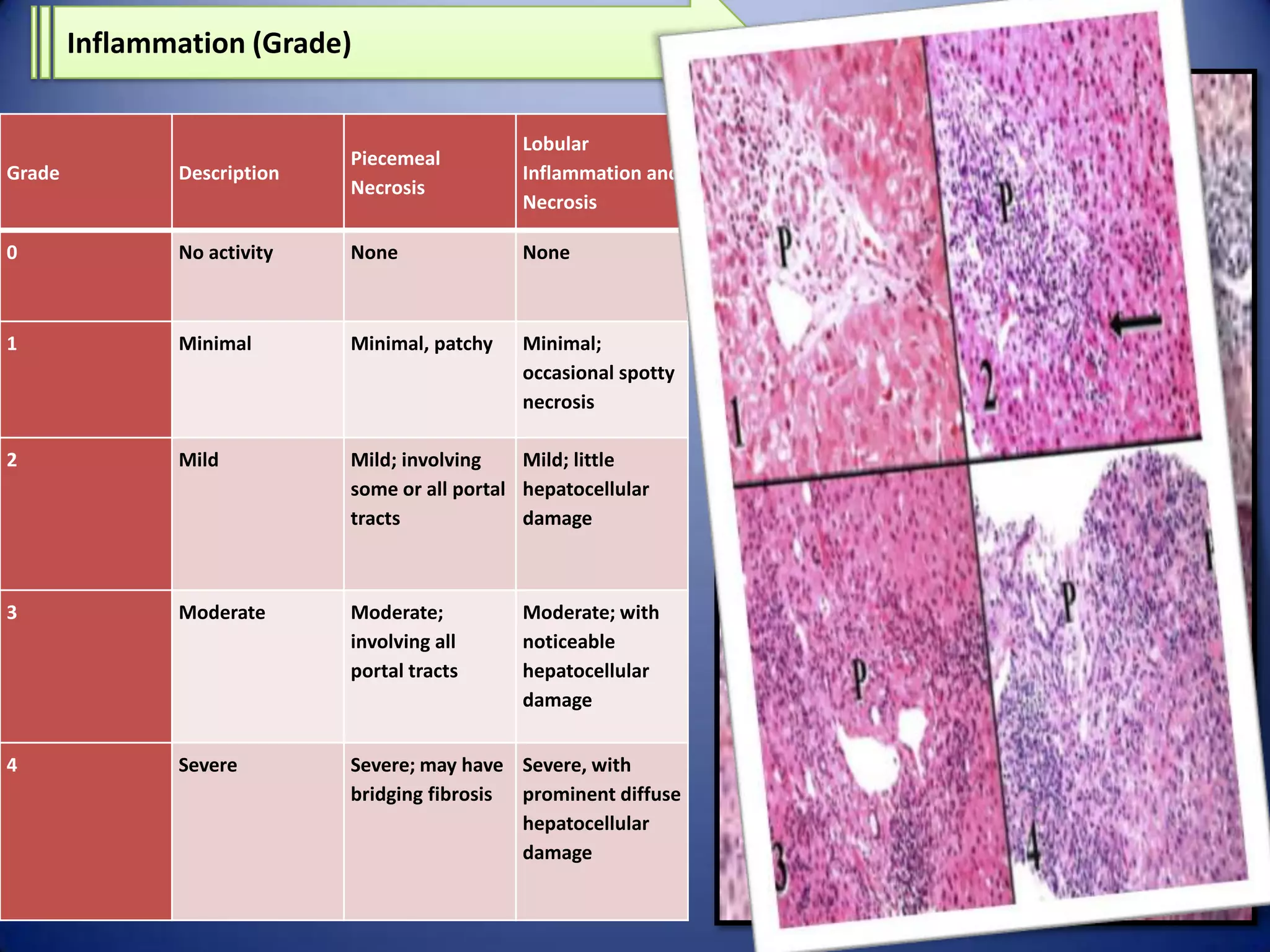 Inflammation (Grade)
Lobular
Inflammation and
Necrosis

Grade

Description

Piecemeal
Necrosis

0

No activity

None

None

1

Minimal

Minimal, patchy

Minimal;
occasional spotty
necrosis

2

Mild

Mild; involving
Mild; little
some or all portal hepatocellular
tracts
damage

3

Moderate

Moderate;
involving all
portal tracts

4

Severe

Severe; may have Severe, with
bridging fibrosis prominent diffuse
hepatocellular
damage

Moderate; with
noticeable
hepatocellular
damage

 
