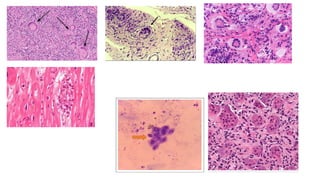 Chronic inflammation-1 mbbs ppt pathology.pdf