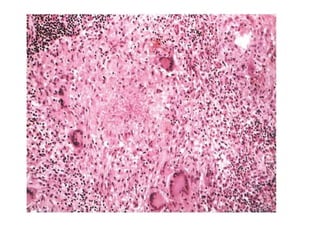 Chronic inflammation