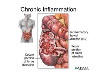 Chronic inflammation Slide 12