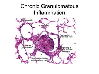 Chronic Granulomatous
Inflammation
 