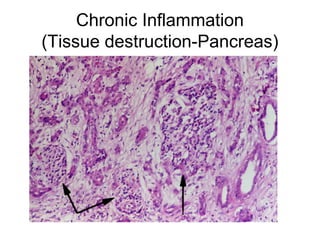 Chronic Inflammation
(Tissue destruction-Pancreas)
 
